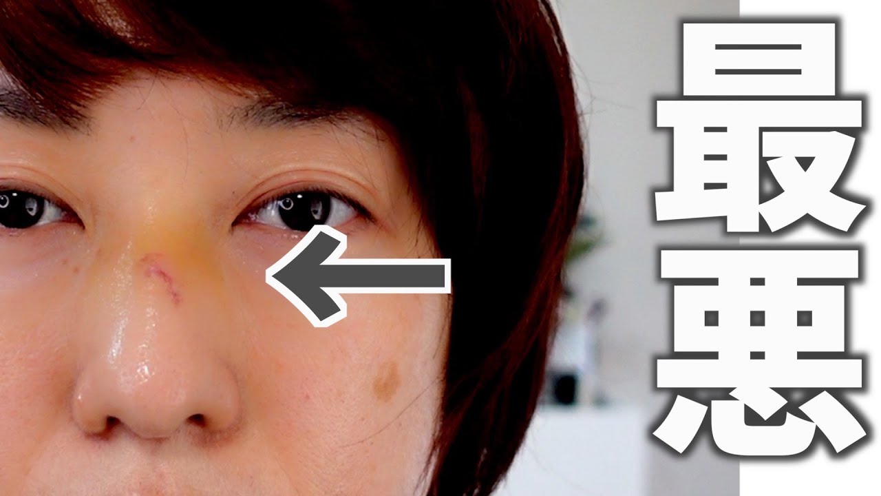 【閲覧注意】壁にぶつかって顔を怪我しました。あの最強アイテムで隠します【ベースメイク】