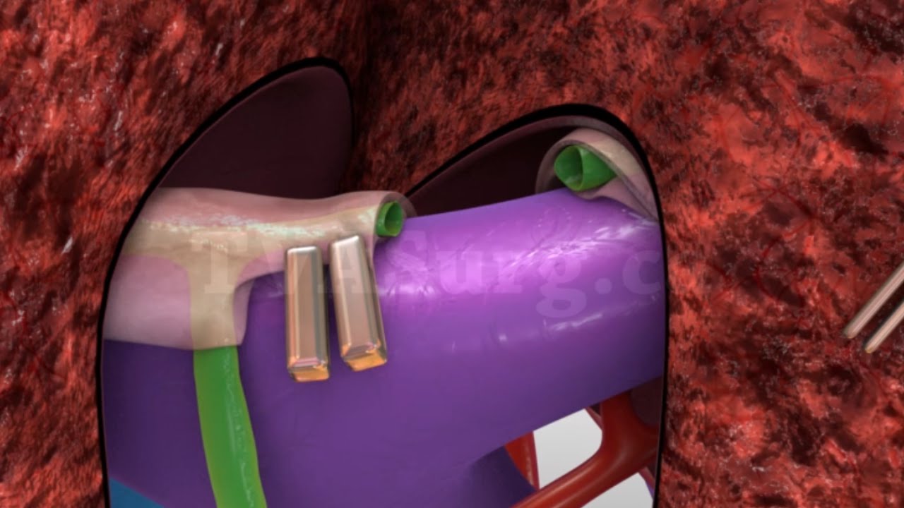 Liver transplant: Living donor left lateral hepatectomy