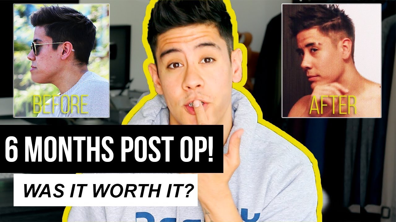 WAS MY JAW SURGERY WORTH IT??? 🤔 (6 MONTHS POST OP RESULTS!) | JAIRWOO