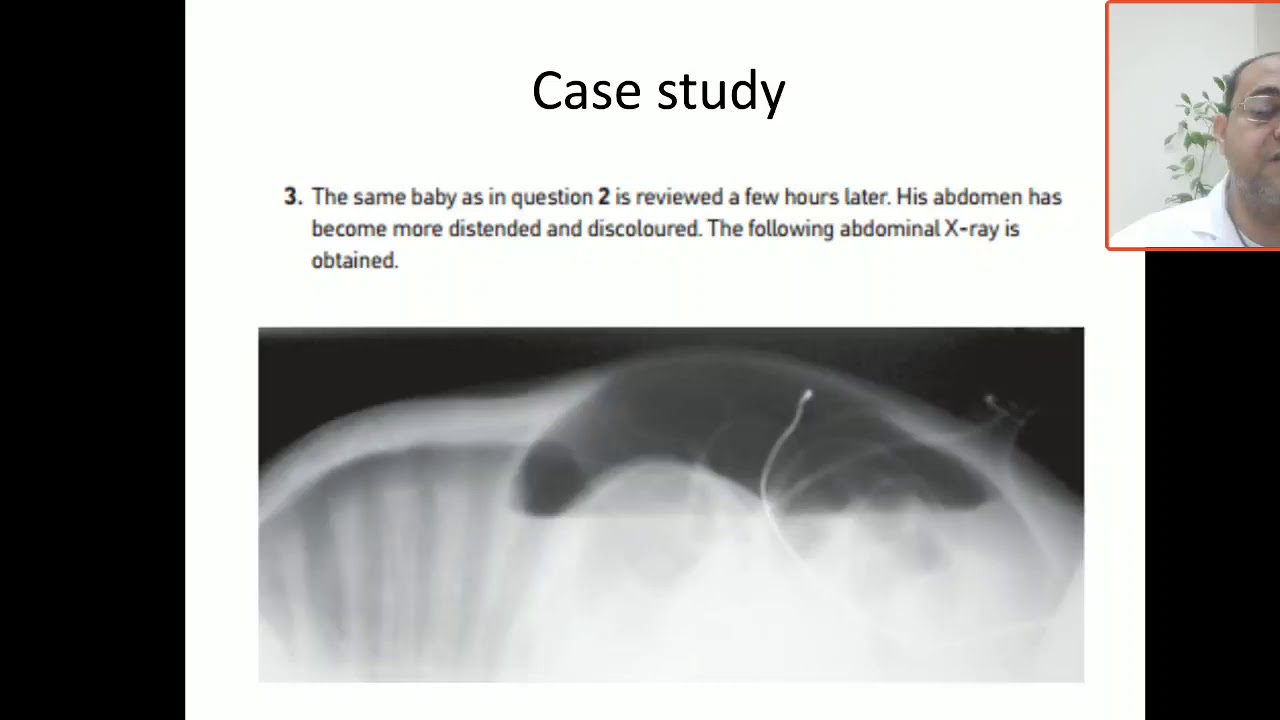 Case 84 intestinal perforation, pneumoperitoneum, complicated NEC,  free air under ther diaphragm
