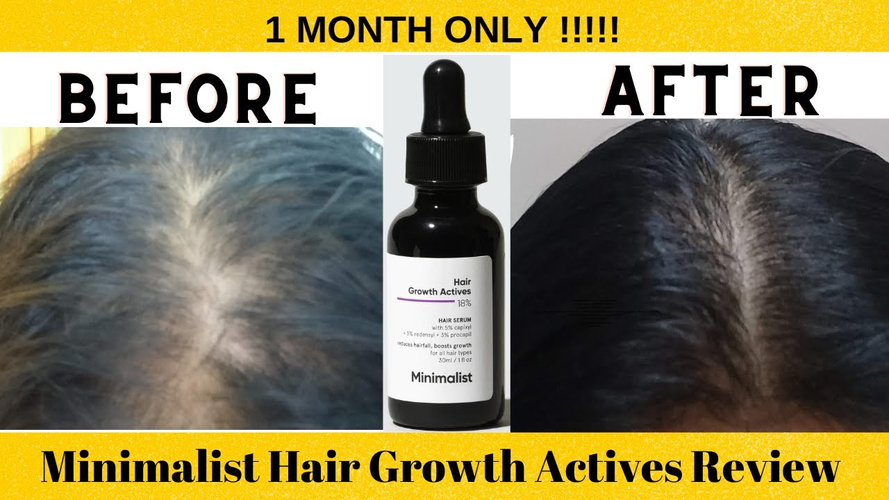 Hair Loss | Minimalist Hair Growth Actives Update | Minimalist Hair Serum Review