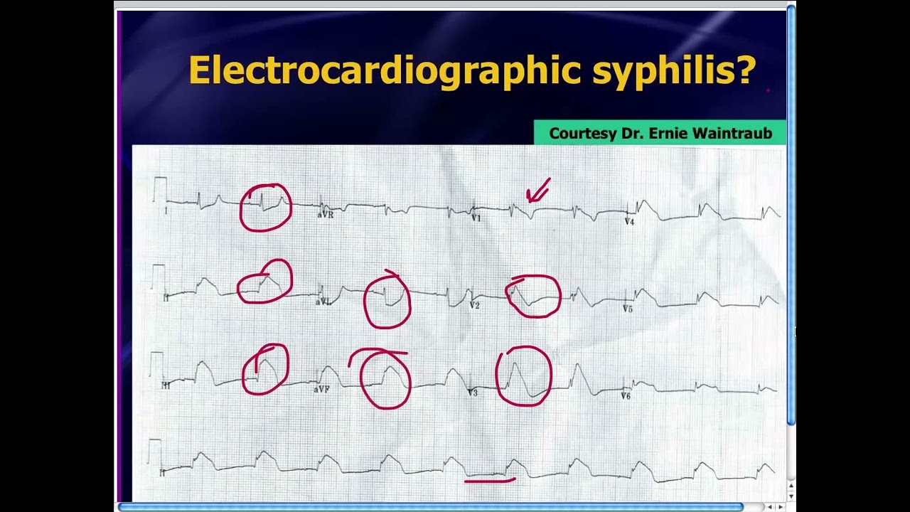 Amal Mattu's ECG Case of the Week_ Oct 14, 2013