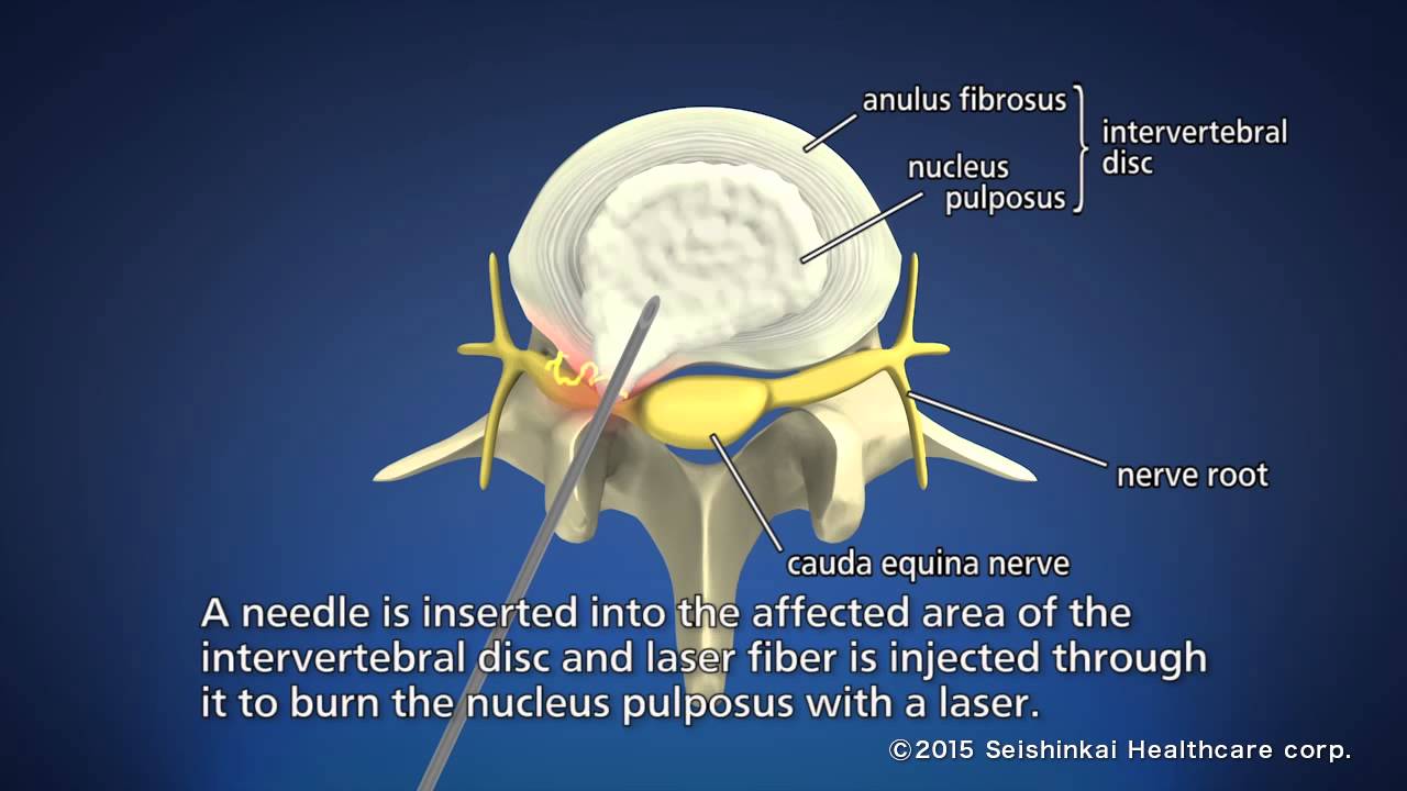 Treatment of lower back pain (PLDD Therapy)