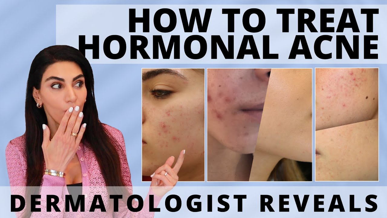Dermatologist Unveils How to Treat Hormonal Acne | #acne #acnetreatment #hormonalacne
