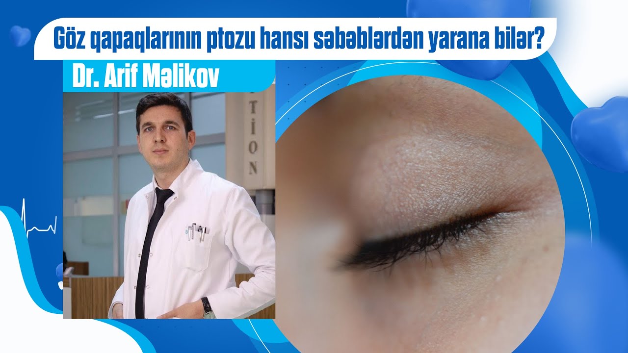 Göz qapaqlarının ptozu hansı səbəblərdən yarana bilər?