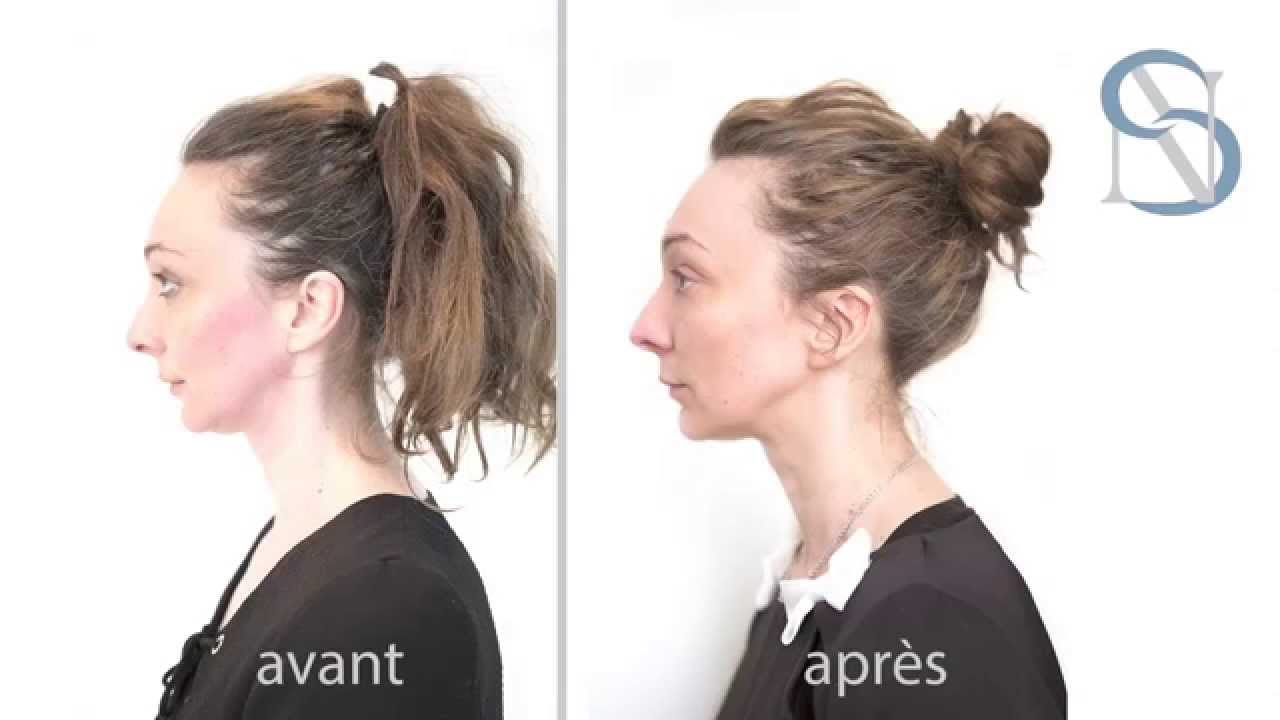Ulthera ou Ultherapy au Centre Laser International de la Peau-Paris (CLIPP)