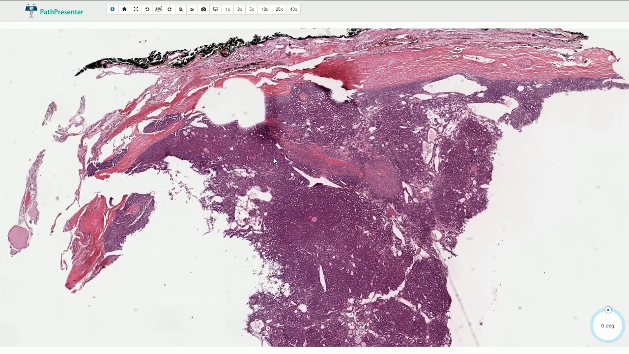 Follicular Carcinoma - Thyroid Gland - Histopathology
