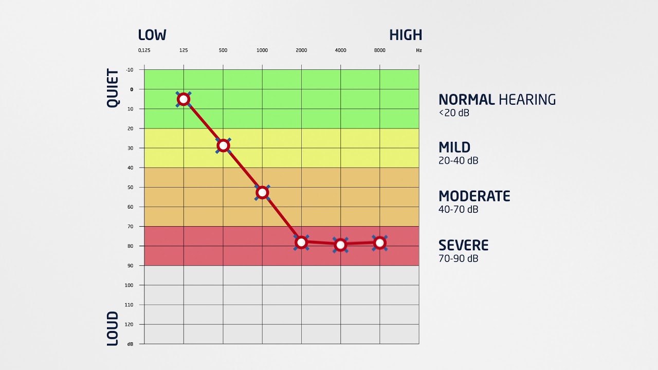 Hear.com - How to Read an Audiogram