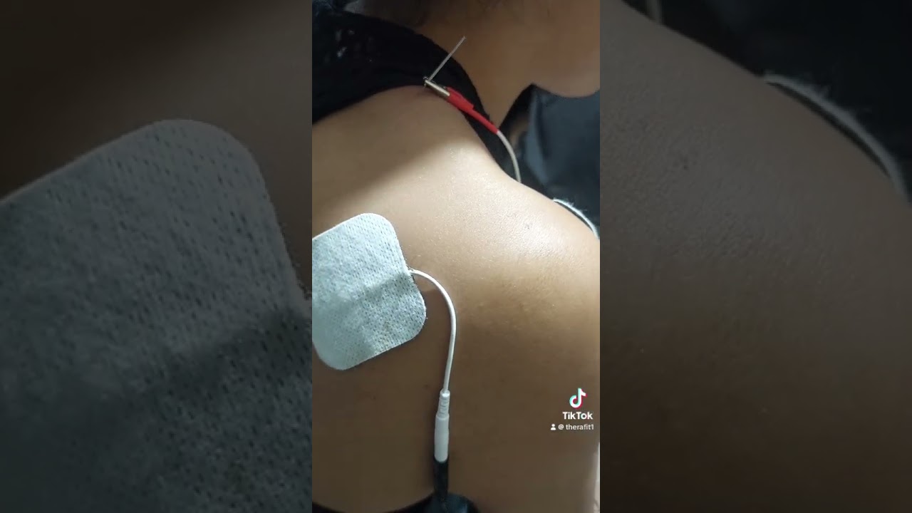 Electropuncion&hellip;tratamiento en electroterapia para paciente con lesi&oacute;n slap y tendinopatia de hombro