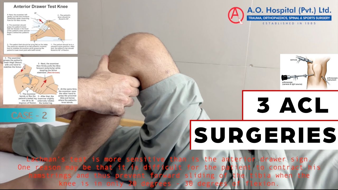 ACL RECONSTRUCTION