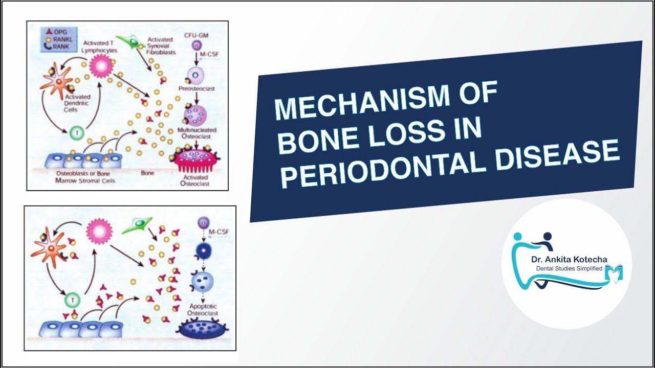 MECHANISM OF BONE LOSS IN PERIODONTAL DISEASE/RANK-RANKL-OPG AXIS/RANKL:OPG RATIO/DR. ANKITA KOTECHA