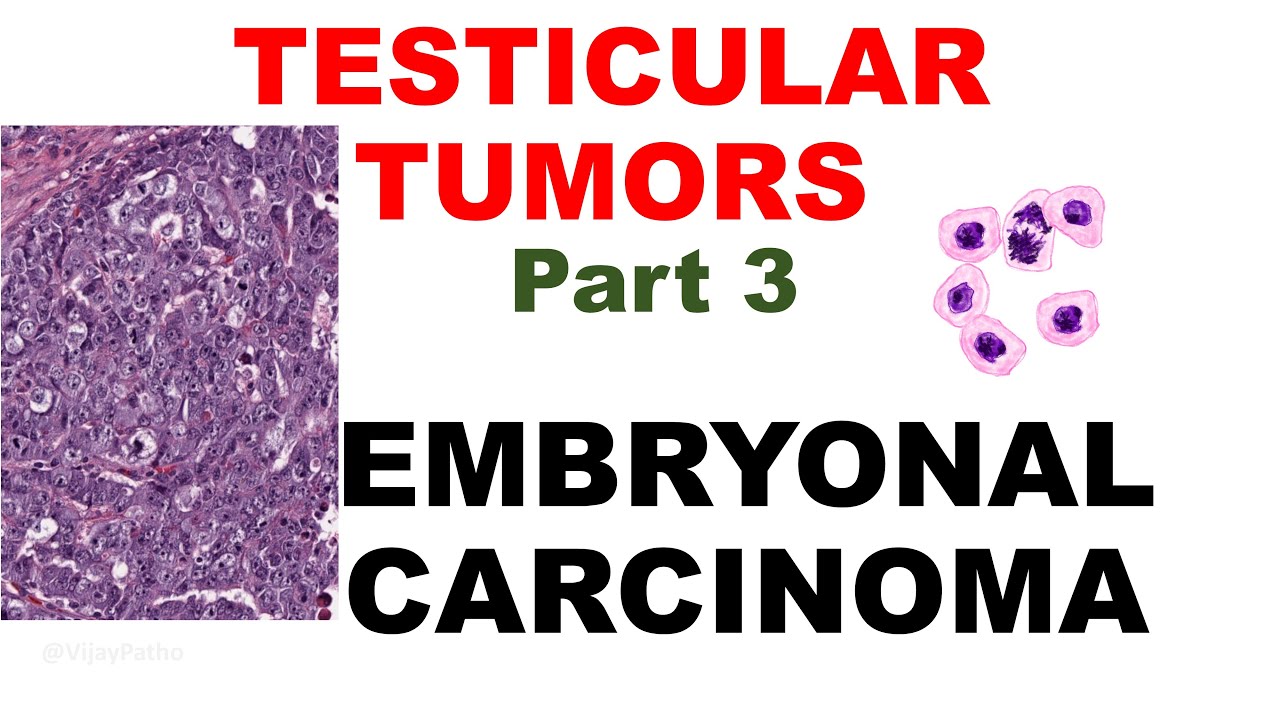 EMBRYONAL CARCINOMA- Etiopathogenesis , Clinical features , Morphology & Treatment