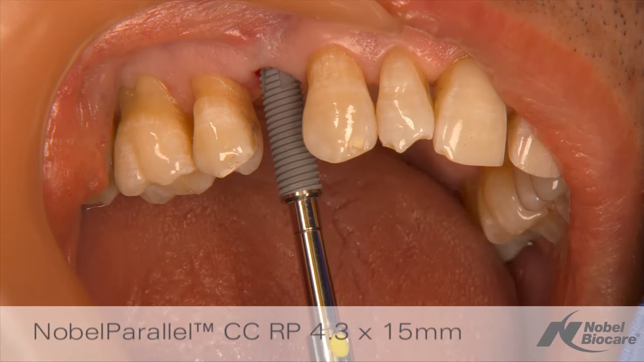 Immediate placement & provisionalization in maxillary esthetic zone │ NobelGuide & NobelParallel CC