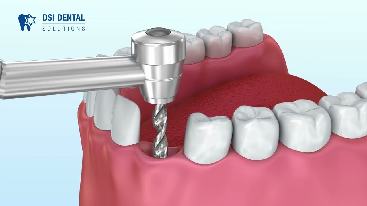 Impact of Drill Selection in Implantology Success Rate - Dmitry's Blog #7