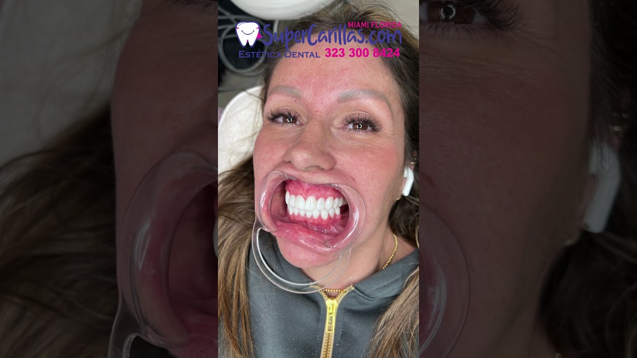 Carillas Dentales Antes y Despu&eacute;s | Dise&ntilde;o de Sonrisa con Porcelana y Resina