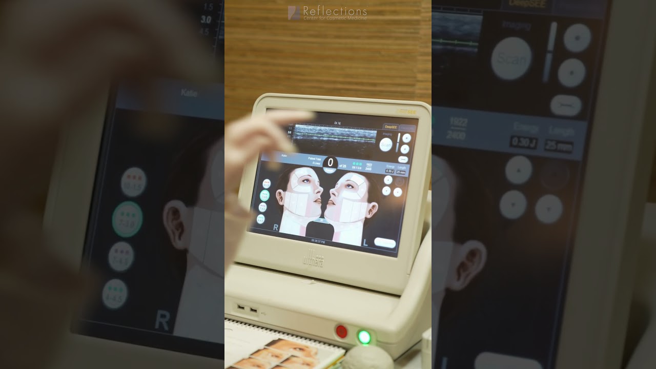 Ультразвуковая терапия (Ultherapy) и технология Sofwave для подтяжки бровей.