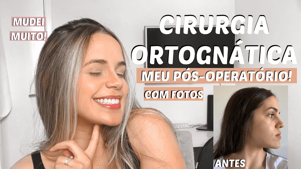 TUDO SOBRE MINHA CIRURGIA ORTOGNÁTICA | Antes e Depois da Cirurgia Ortognática