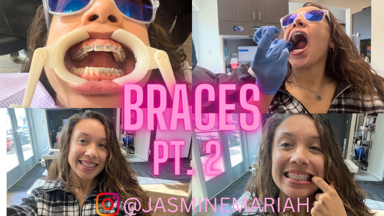 Adult Braces Vlog | Come with me to get braces At 25 Part 2 !!