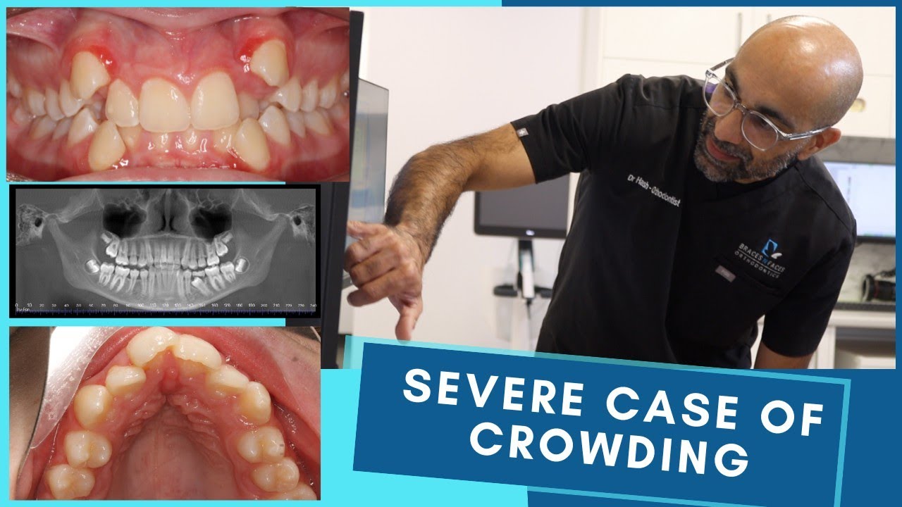 How To Fix Severe Dental Crowding?