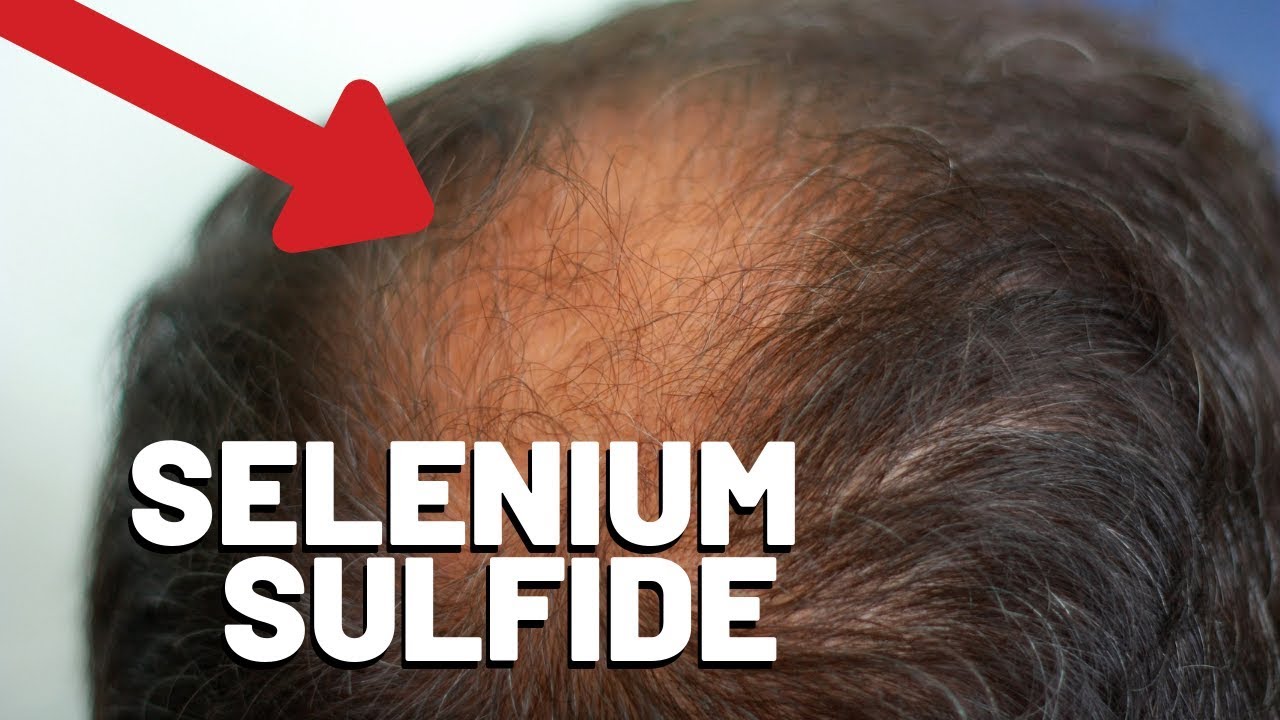 Selenium Sulfide and Hair Loss - Is There a Connection?