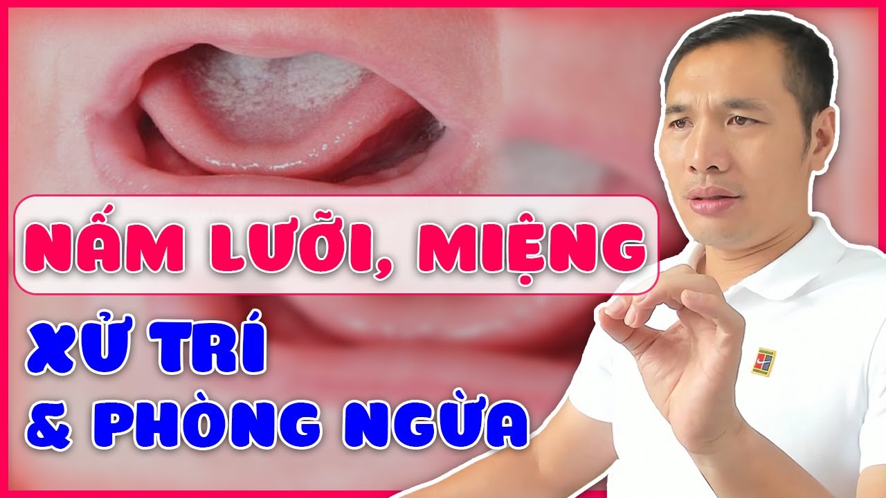 Trẻ bị NẤM LƯỠI, NẤM MIỆNG xử trí như thế nào? Cách phòng ngừa và điều trị| Dược sĩ Trương Minh Đạt