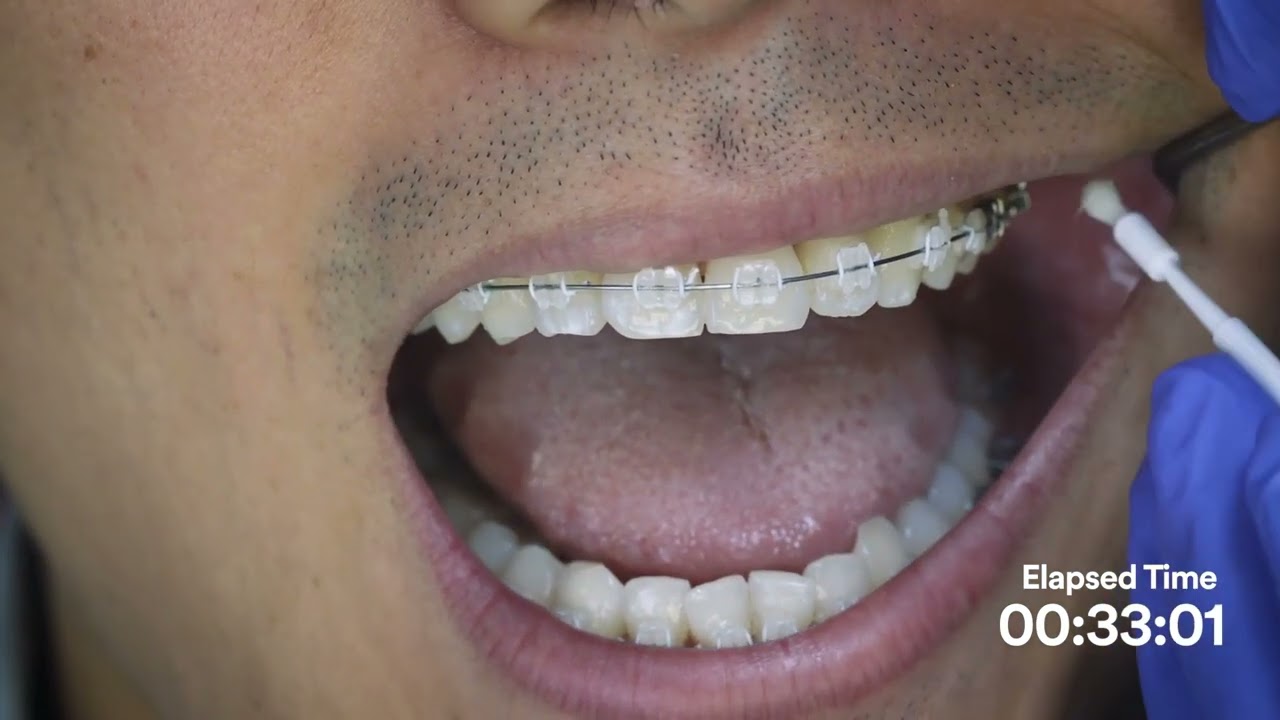 Application of Vanish White Varnish on Ortho Patient