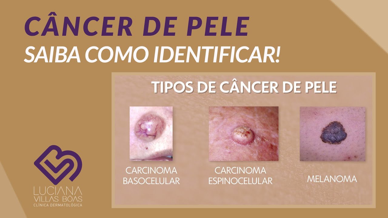 CÂNCER DE PELE - COMO IDENTIFICAR E CONHEÇA OS TIPOS