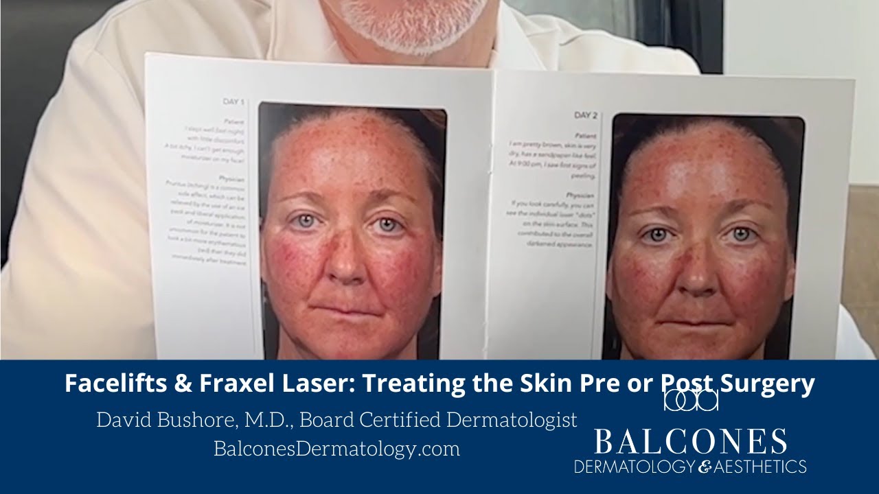 Facelifts & Fraxel-Treating the Skin for Optimal Results | David Bushore, M.D.| Ph: 512-459-4869