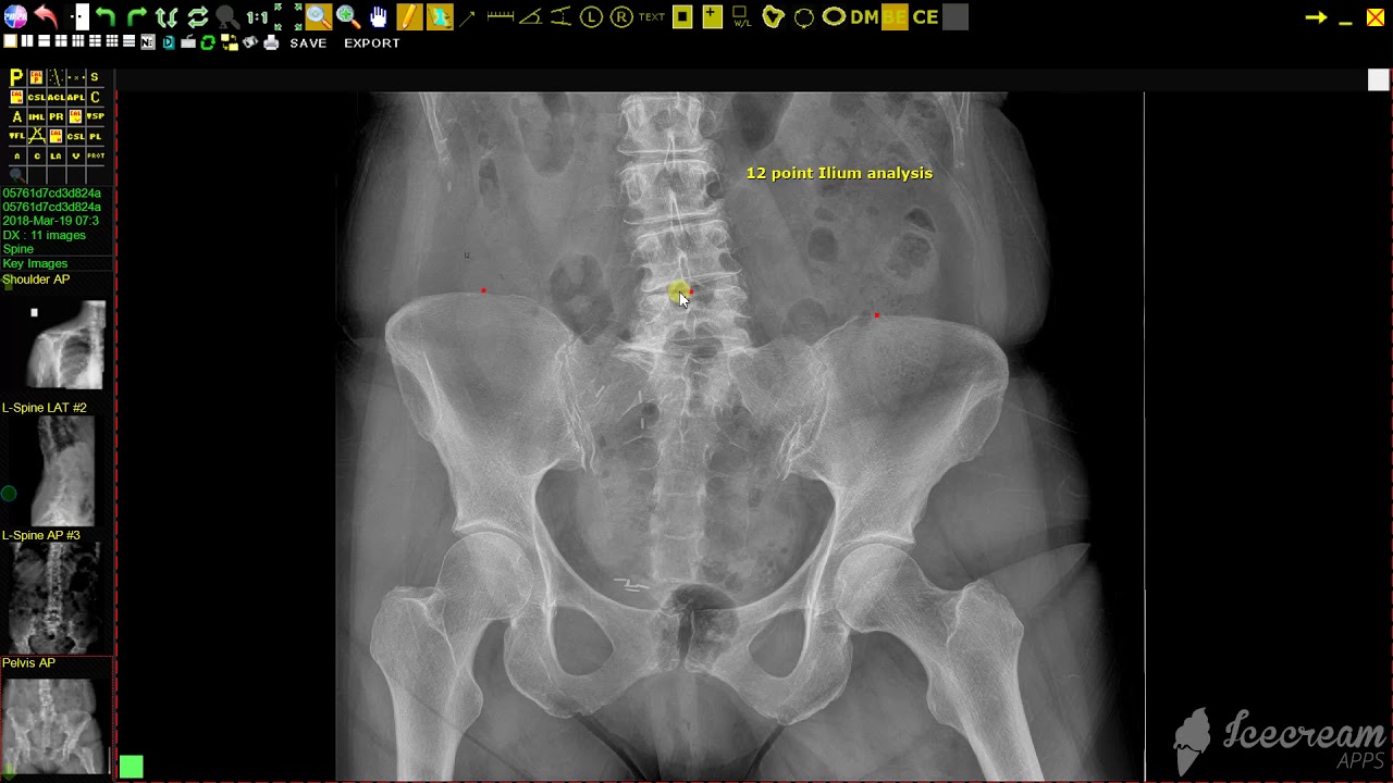 20/20 Imaging Opal-Rad (Chiropractic) 12 Point Ilium Analysis