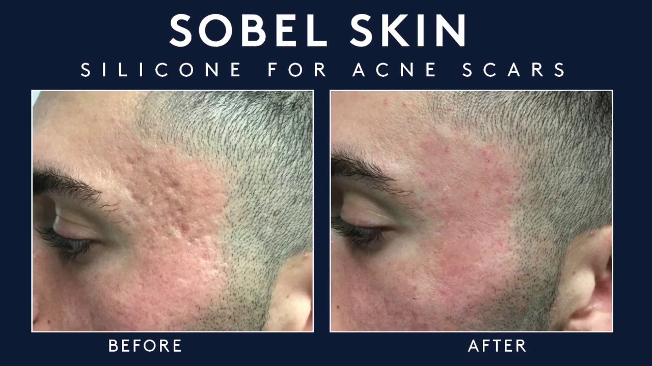 Acne Scarring Treatments Available in NYC