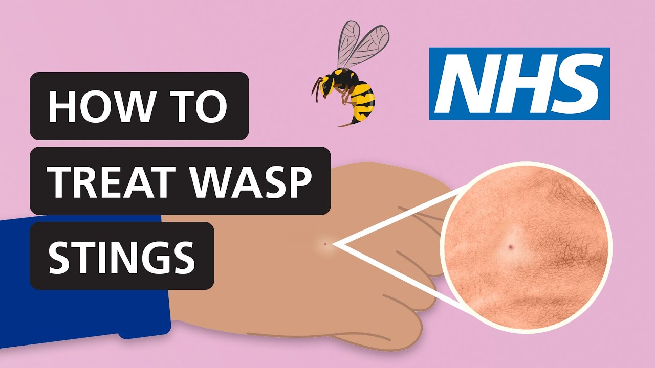 How to treat wasp stings at home | NHS