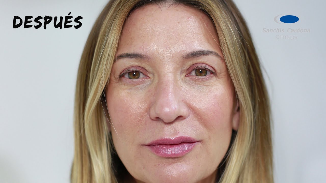 Peeling facial con ácido tricloracético