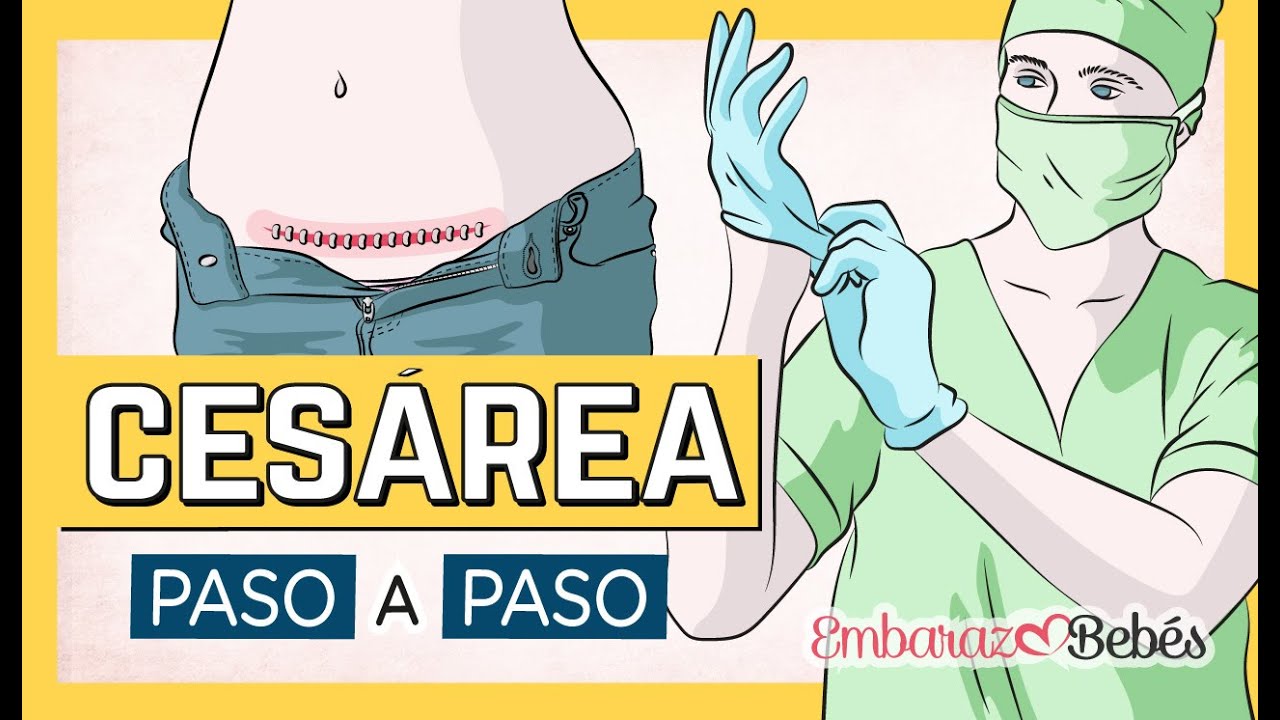 🔴 🐣 PARTO por CESÁREA: Paso a paso