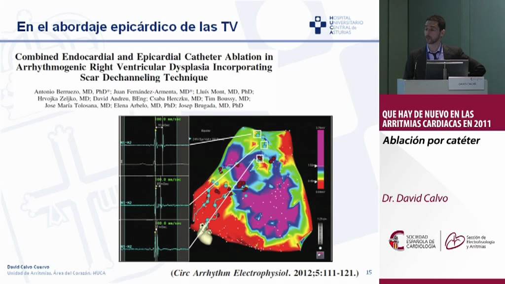 Ablaci&oacute;n por cat&eacute;ter. Dr. David Calvo.
