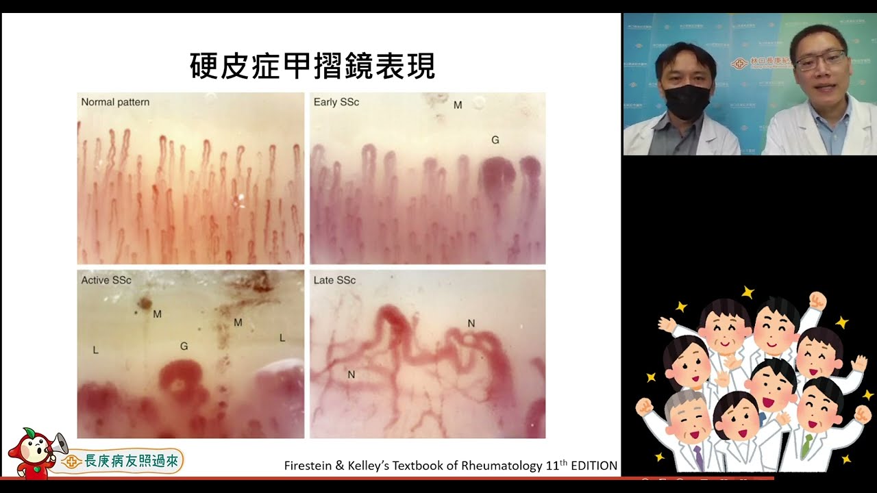 你有硬皮症嗎?教你及早發現及面對