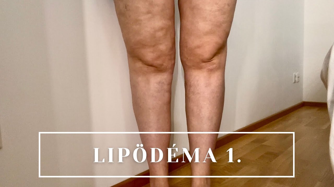 A LIPÖDÉMÁRÓL, EGYSZERŰEN | TÜNETEK, KEZELÉS STB… | PART 1.