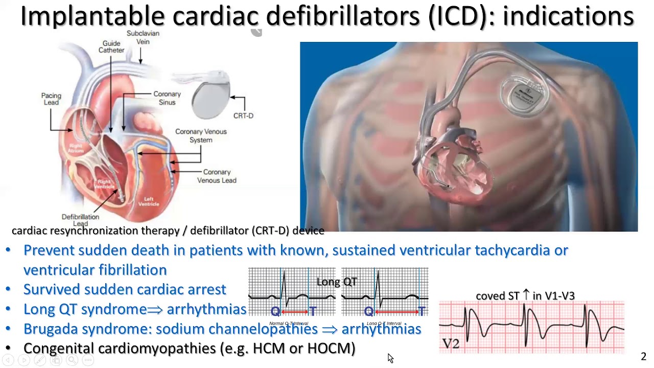Permanent pacemakers and implantable cardiac defibrillators for exercise pros part 2: ICD:the basics