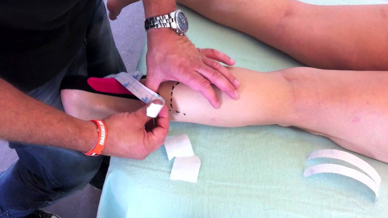 Kinesio tape for hælspore