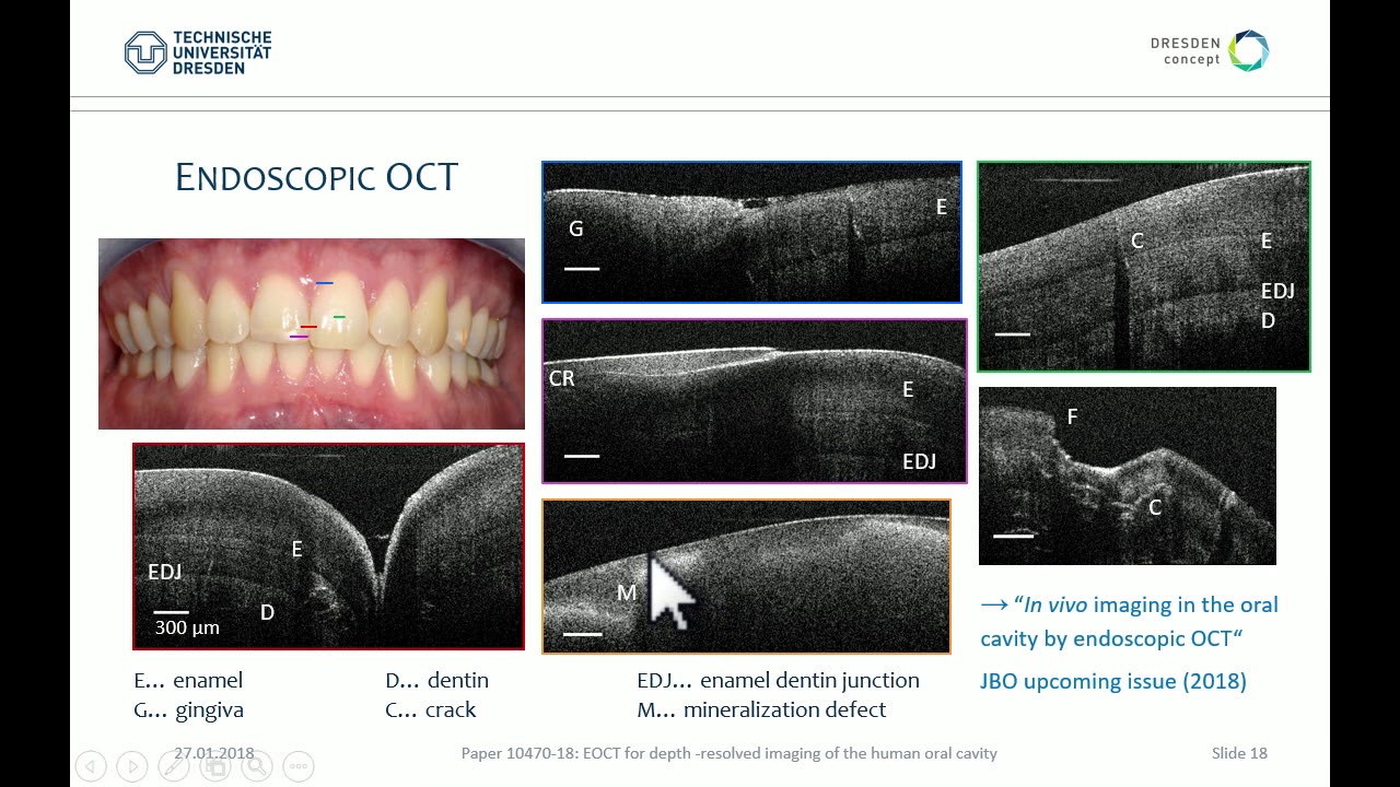 Julia Walther: Optical coherence tomography in the oral cavity