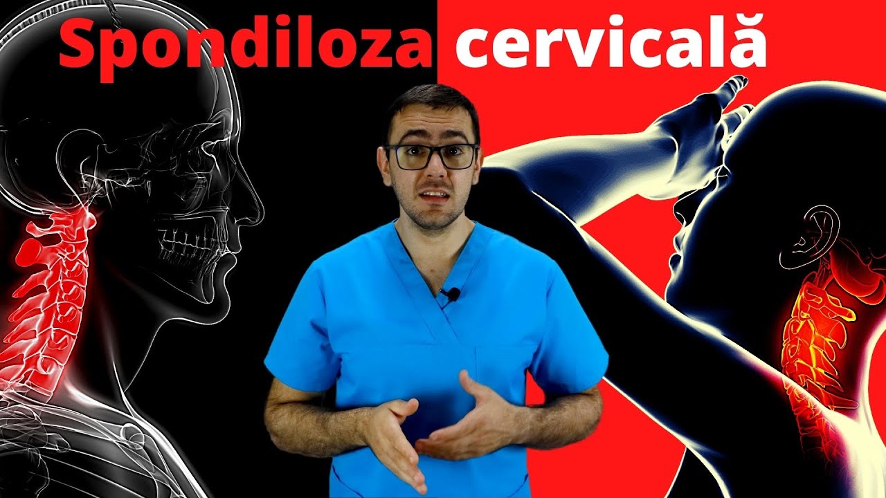 Cum poți trata spondiloza cervicală. #kinetoterapie  cervicală