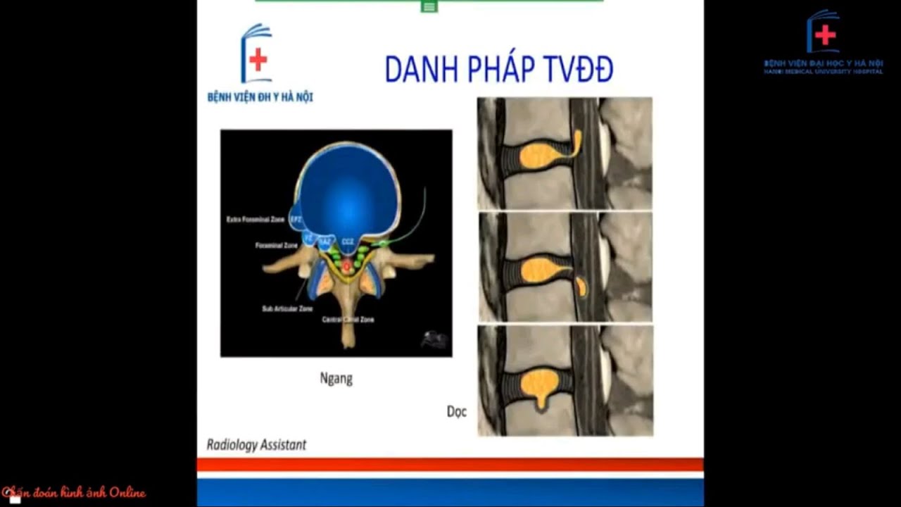 CHẨN ĐOÁN HÌNH ẢNH THOÁT VỊ ĐĨA ĐỆM CỘT SỐNG THẮT LƯNG | TS. BS. NGUYỄN NGỌC CƯƠNG