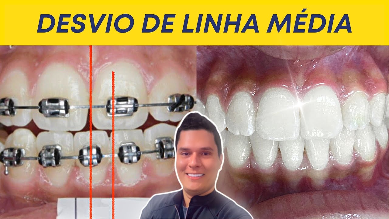 Relato de caso | DESVIO DE LINHA MÉDIA SUPERIOR | COMO CORRIGIMOS?