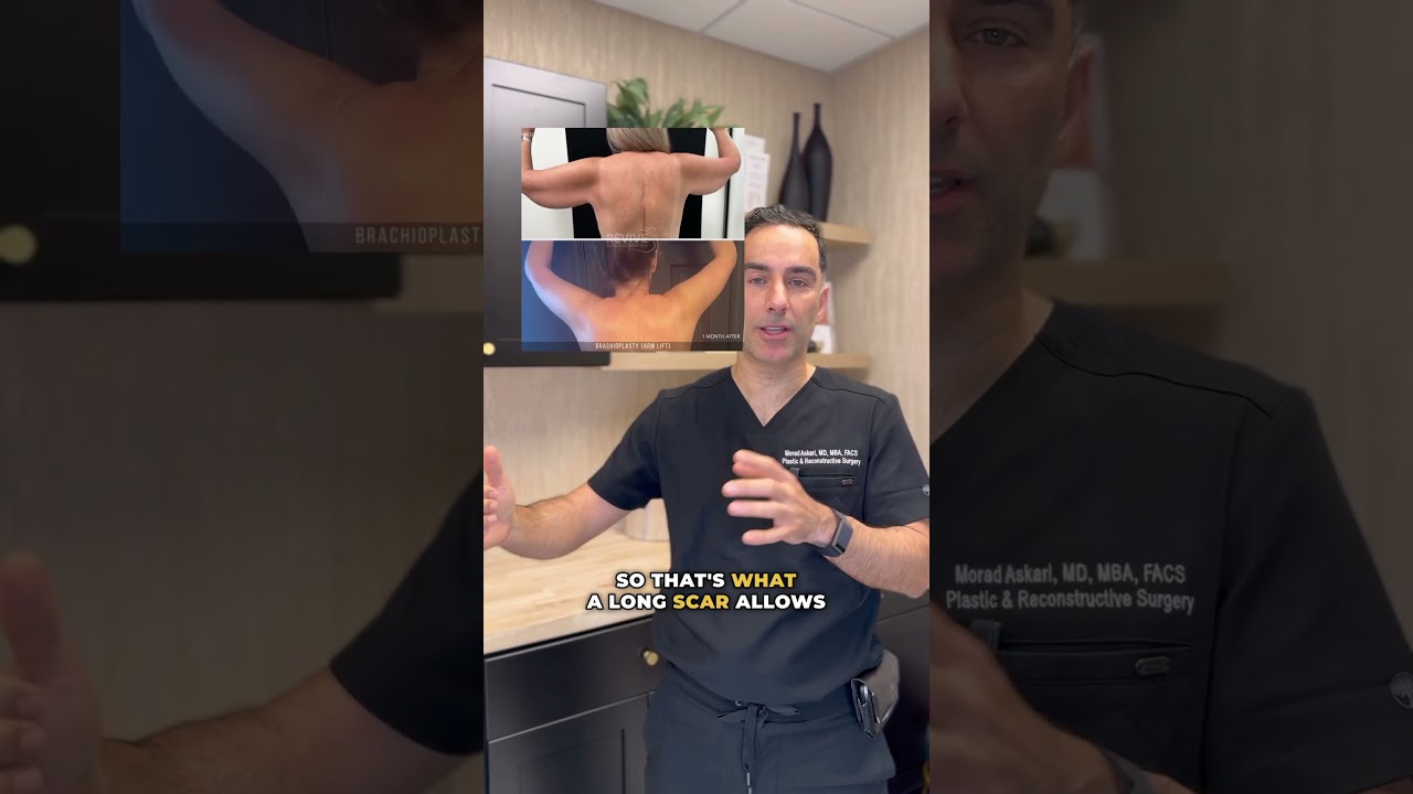 Arm Lift - aka Brachioplasty