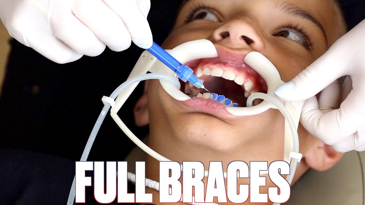 GETTING BRACES FOR THE FIRST TIME FOR THE SECOND TIME | TOP AND BOTTOM BRACES PUT ON AGAIN