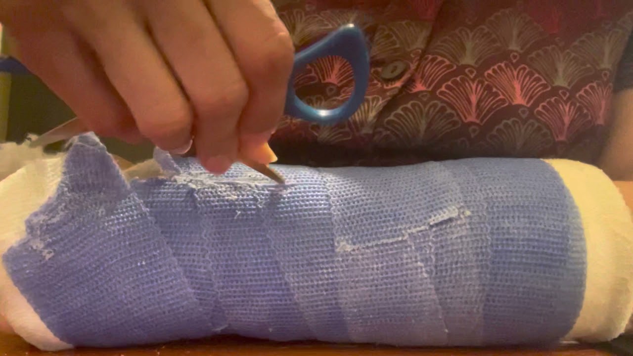 How to remove a cast at home - part 2