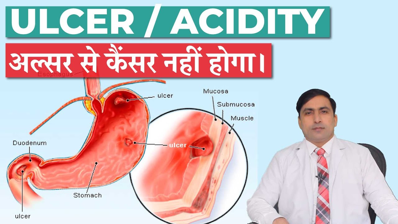 अल्सर की बीमारी | पेट में एसिडिटी | ULCER SYMPTOMS, PREVENTION, TREATMENT | in HINDI