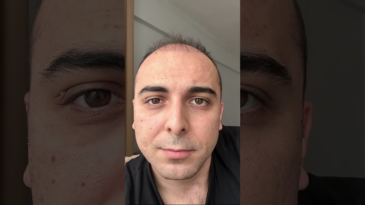 Saç ekimi sonrası 100.gün 