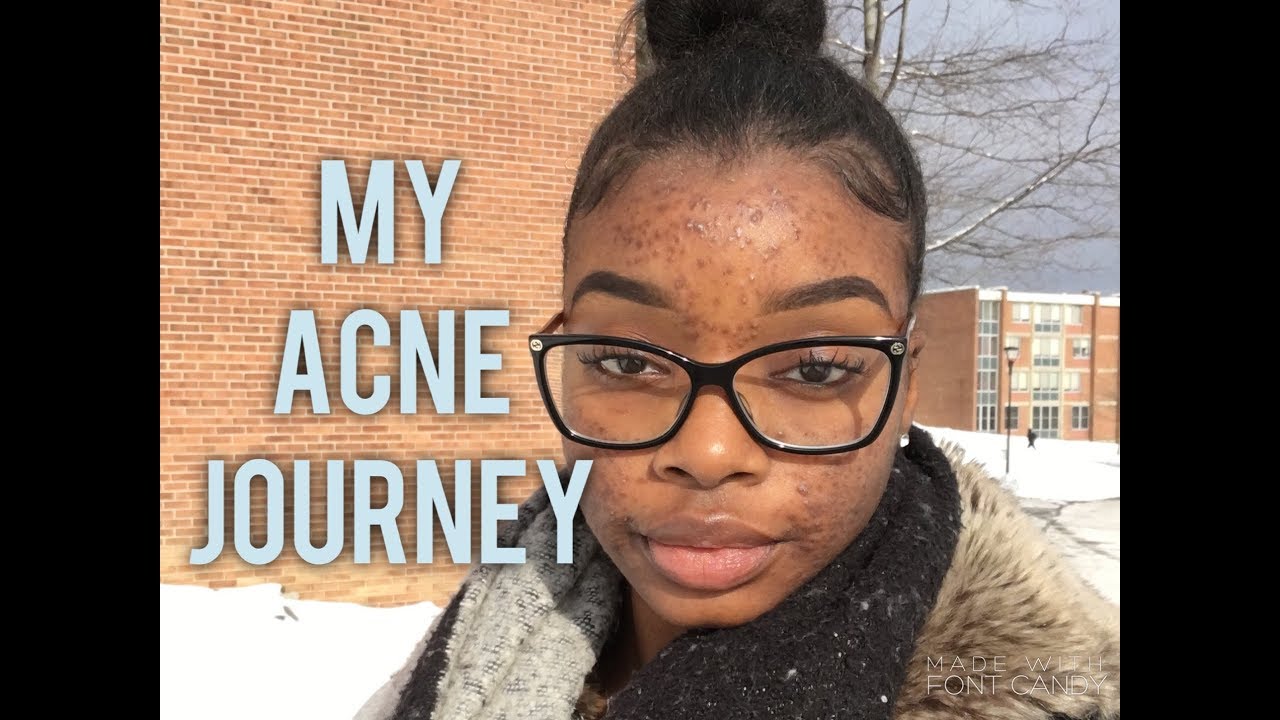 My Acne Journey + Pictures | How to Be Confident with Acne