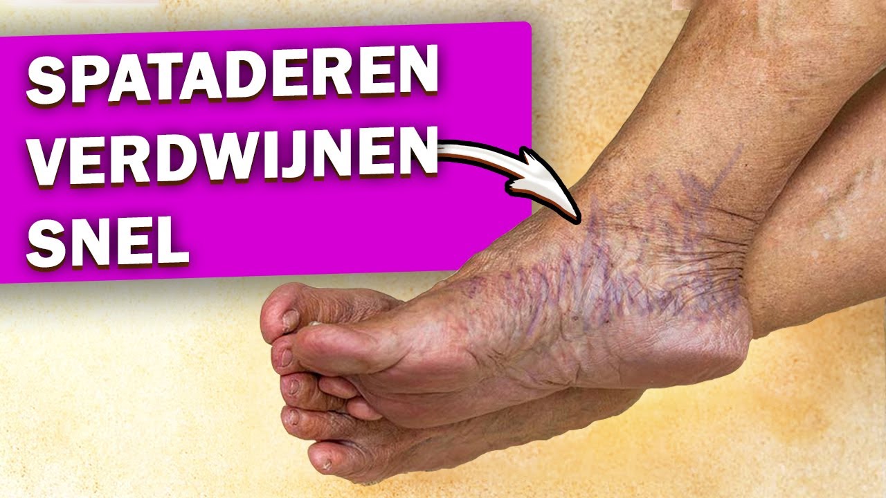 Hoe verwijder je spataderen op je benen?