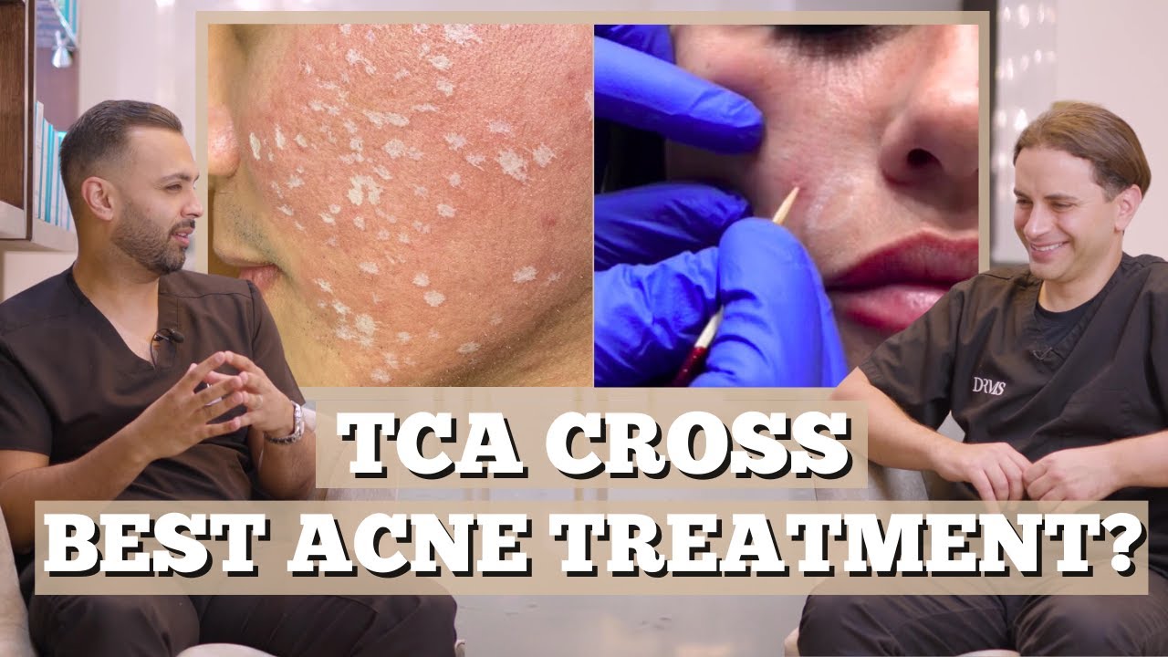 TCA Cross Best Acne Treatment | Dr. Somji & Solomon Discuss
